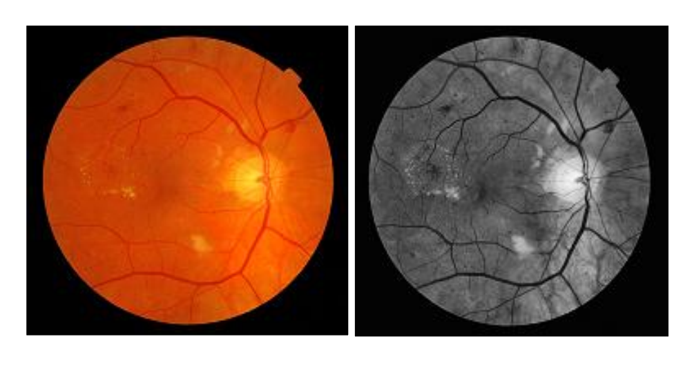 Diabetic Retinopathy Publication
